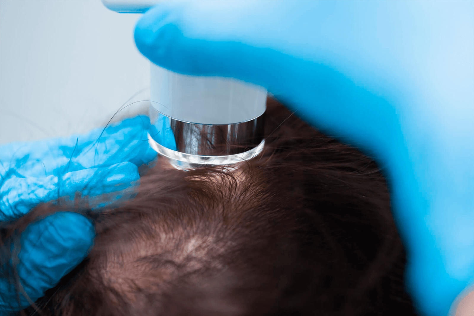 Exossomos na Tricologia: O futuro da comunicação celular no combate à calvície