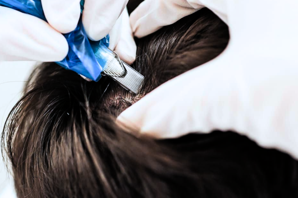 MMP Capilar em Barretos: A tecnologia de performance para frear a calvície antes do transplante