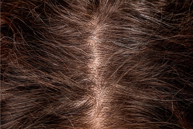 Erros Fatais no Banho de Outono/Inverno Que Estão “Cozinhando” a Raiz do Seu Cabelo