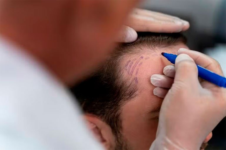 Transplante Capilar Cura a Calvície? A Verdade Científica sobre a Técnica FUE e os Limites da Restauração Capilar