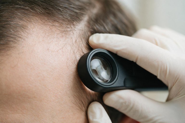 Close-up de exame de tricoscopia na linha do cabelo de paciente masculino